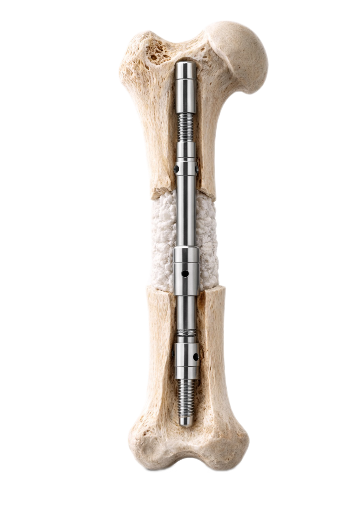 CITadel — modular intramedullary fixator for critical long-bone defects